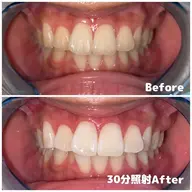 【 歯本来の自然な白さを目指していきます 】🔹高濃度ナチュラルホワイトニング〈 30分照射 〉🔹