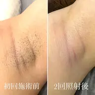 【再来予約専用】全身脱毛(顔・VIO込)