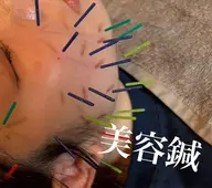 【初回来店限定🌈お試し価格】美容鍼💎