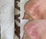 【1ヶ月以内リピーターモニター様❗️】毛穴エクストラクション＋ハーブピーリング🌿✨✨💎モニター