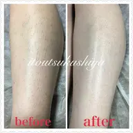 ひざ下の糸脱毛体験🧵