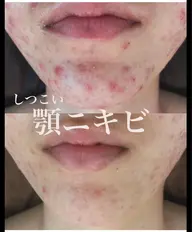 REVI🌿陶肌トリートメント💖剥かないハーブピーリング💗ニキビ、赤み、くすみ、肌荒れ、ブツブツ悩みがある方!!