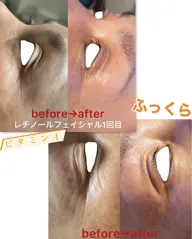 秋の先取り贅沢保湿フェイシャルケア90分（季節の変わり目は肌トラブルが起きやすい時です）