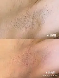 メンズワキ脱毛