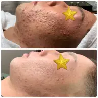 モニター募集【背中ニキビ】VOSトリートメントでニキビを改善します。￥22.000→￥11.000  他返金有♪