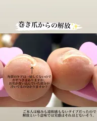 巻き爪からの解放(1本)