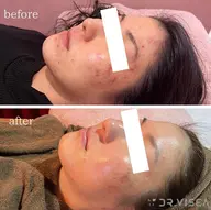 光フォト　即効性　ニキビケア🔥