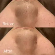 【学割U24初回】学生さん応援★毛穴洗浄¥11,000→¥5,980【クチコミ限定価格】