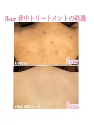 【背中トリートメント】🌿背中の肌悩み、ハーブピーリングにお任せを🌿艶々透明感のあるモデル美肌へ✨✨