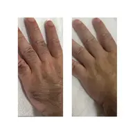 💎脱毛 手の甲・指のみ