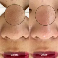 毛穴エクストラクションモニター大募集(1月限定)