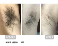 （特別価格50％割引)両ワキ脱毛6回🌸 脱毛初心の方にオススメ  🌸減毛と同時に美白、毛穴引き締め、ツルすべ肌に🌸