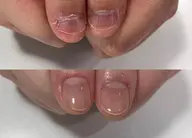 自爪で深爪矯正【噛み、むしり、爪のコンプレックス】