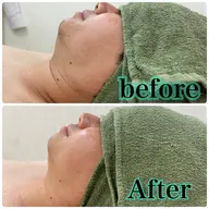 針を使わない脂肪撃退5ml✨たった1回で速攻小顔＆後戻りなし💕お顔専用💕