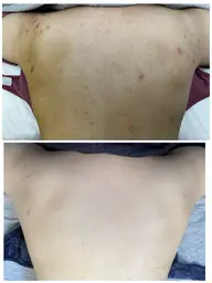 背中トリートメント