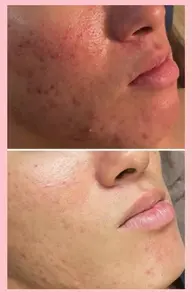 🌿メンズ👨月〜金曜日限定‼️ハーブピーリング&ハイドラ🥰ニキビ、ニキビ跡、毛穴、脂性肌🌿モニターフェイシャル