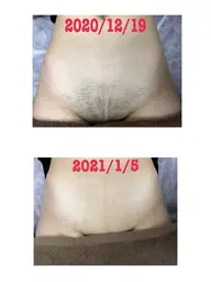 【大人気VIO脱毛】シェービング代込み¥3,900☺️💕専用機使用で痛みほぼ0🙌効果💮🙆‍♀️