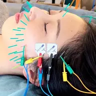 【来店2回目​〜​】EMSをつかった美容鍼
