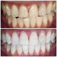 【期間限定】初回6トーンアップ!セルフホワイトニング🦷30分照射⭐️