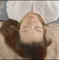 2回目の方限定🌼美容鍼or小顔矯正🌼３０％OFF