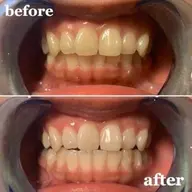 ｡:*🦷初回の方限定🦷✧︎*。15分セルフホワイトニング🐻💕20代の女性ホワイトニングお試しコース🌈🤍