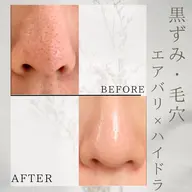 モニター価格📷【期間限定】≪鼻のみ👃≫毛穴洗浄(ハイドラ👃)+💎温感スキンインフュージョン🚹男性も◎