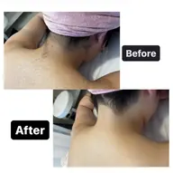 【うなじ脱毛】シェービング付💓手が届かない場所だからこそプロにお任せ下さい💁‍♀️成人式やイベント前にオススメ🪞✨