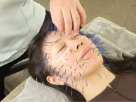 美容鍼NO2【美容鍼+全身調整鍼+幹細胞化粧水】プレミアムコース