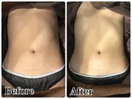 お腹痩身（キャビテーション＋ラジオ波→マッサージ）👯‍♀️⭐️