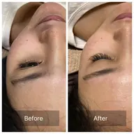 お試し全顔糸脱毛　糸一本のみ【通常は3本】