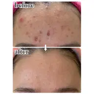 光フェイシャルお試し