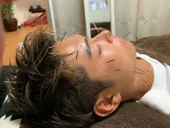 【メンズ美容鍼】男性も大歓迎❇️電気を長す美容鍼灸