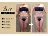 《お腹二の腕背中》ハイパーナイフ+マッサージ６０分￥9000→3500