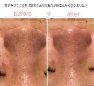 毛穴を目立たなく！ピーリング＆ハイドラ洗浄×世界特許ヒト幹細胞を使用するエレクトロポレーションで「加工いらずの艶肌」へ