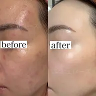 プラズマAir ニキビケア、ピーリング