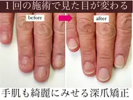 【深爪矯正★女性ハンド】お試し1回体験