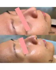 フラワーハーブピーリング