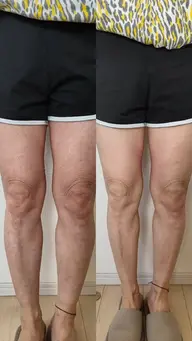 ２回目以降の方【10名限定🔥】集中痩身キャビコース｜45分1部位 通常1回6,000円が5,000円の10回コース！！