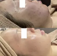 14日限定🌸新生活に🌸【フェイシャル×顔脱毛】全顔IPL照射で美肌×毛穴レス🩵今だけピーリングと美容液導入付💫