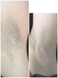 痛くない　わき脱毛　ミニモ限定価格キャンペーン　￥980 （女性限定）