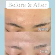 🍒*˖°全顔脱毛*˖°🍒最新THR方式で効果重視♦︎化粧ノリ&化粧水の浸透率UP🎶