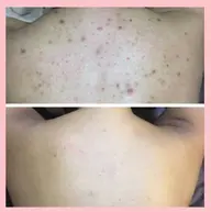 Bodyハーブピーリング🌿(ハード剥離あり)背中、腰、二の腕、お尻、デコルテ等🩵吹き出物、毛穴のザラつき、色跡に🩵