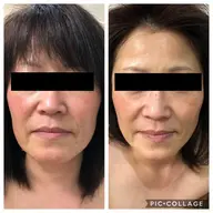 効果絶大!大人気BBL光フェイシャル★クレイパックプレゼント♪