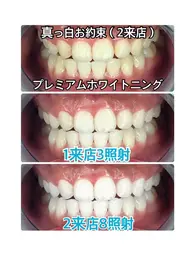 【☆断トツ1番人気☆】プレミアムセルフホワイトニング《2来店メニュー》