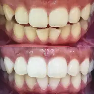 【本気で白い歯にしたい方へ】8分照射×4回🦷ノーマルセルフホワイトニング