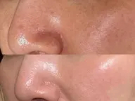 【本格シミ改善】剥離ハーブピーリング＆顔リンパマッサージ¥23000→