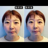 【ほうれい線・左右差を整えるスペシャルケア】美容整体×EMS3種×美容鍼