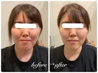 【即効性＆持続力】即効小顔/乾燥くすみ　小顔専用機器フェイシャル