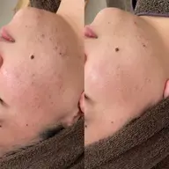 【4/9当日限定🉐】ハーブピーリング🌿剥離あり🪿毛穴洗浄付✨