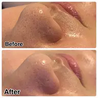 【ご新規様限定🌟毛穴洗浄+鼻パック】しつこい角栓や黒ずみごっそり洗浄×鼻パックでツルツルに！